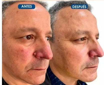 Parches™ - Elimina verrugas sin dolor y seguro + ENVIO GRATIS