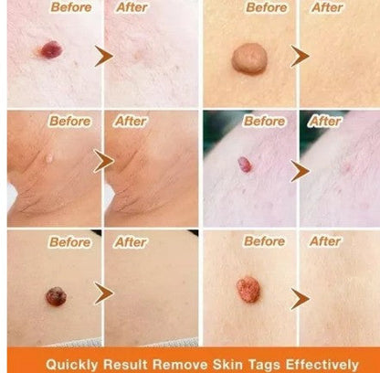Parches™ - Elimina verrugas sin dolor y seguro + ENVIO GRATIS