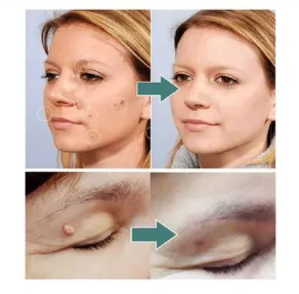 Parches™ - Elimina verrugas sin dolor y seguro + ENVIO GRATIS